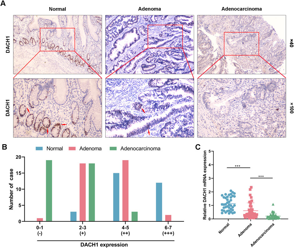 SEBM | Aberrant DNMT1-mediated DACH1 methylation is associated with ...