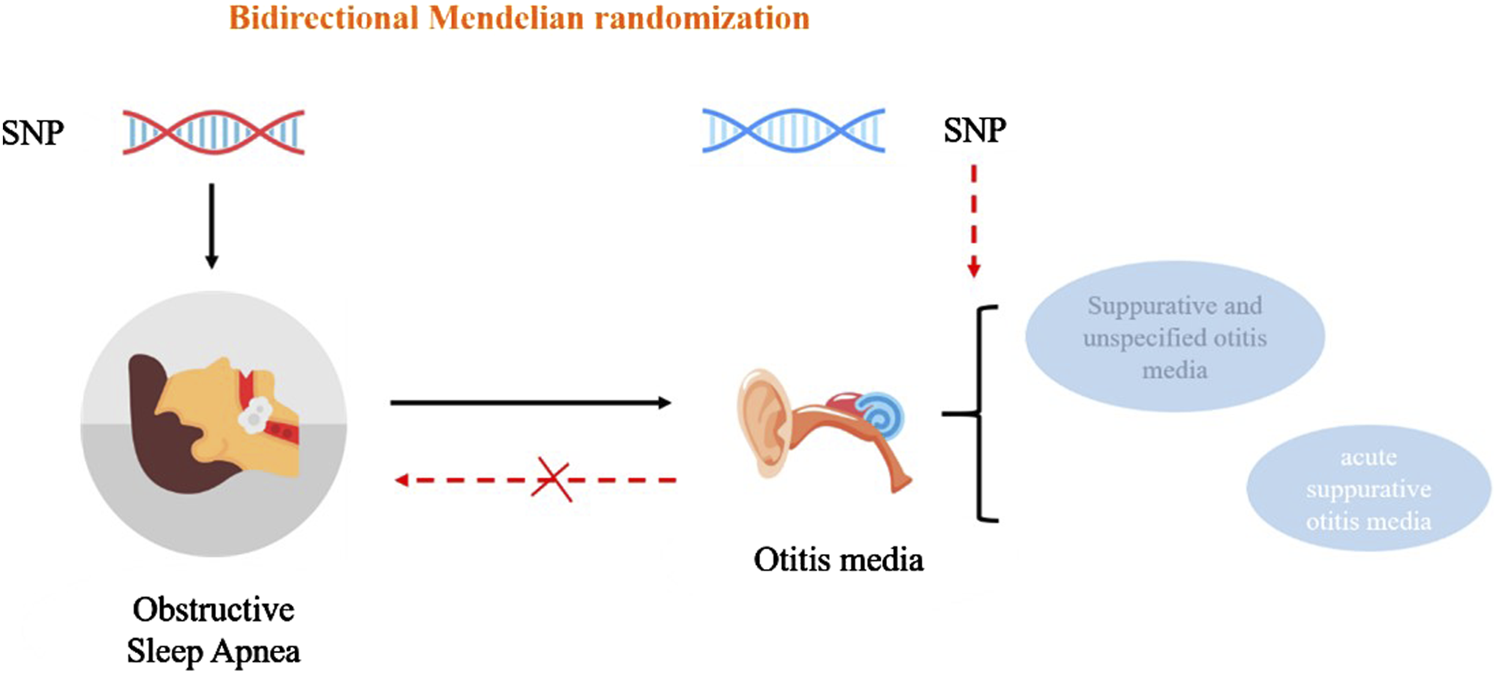 Diagram of bidirectional Mendelian randomization showing the relationship between obstructive sleep apnea and otitis media. SNPs influence both conditions. Obstructive sleep apnea does not lead to otitis media, but SNPs related to otitis media can result in suppurative and unspecified or acute suppurative otitis media.