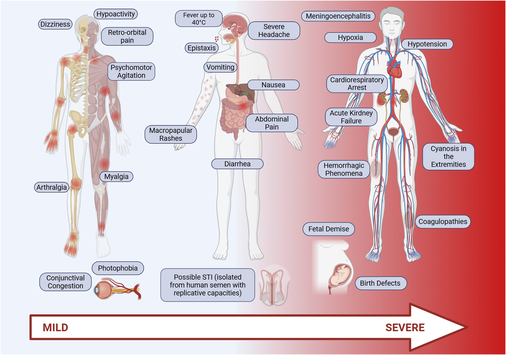 Illustration showing symptoms of an illness ranging from mild to severe. Mild symptoms include dizziness, photophobia, retro-orbital pain, arthralgia, myalgia, nausea, and diarrhea. Severe symptoms include fever, vomiting, cardiorespiratory arrest, acute kidney failure, hemorrhagic phenomena, cyanosis, and coagulopathies. The progression is depicted by a color gradient from blue to red.